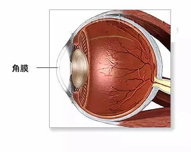 角膜移植